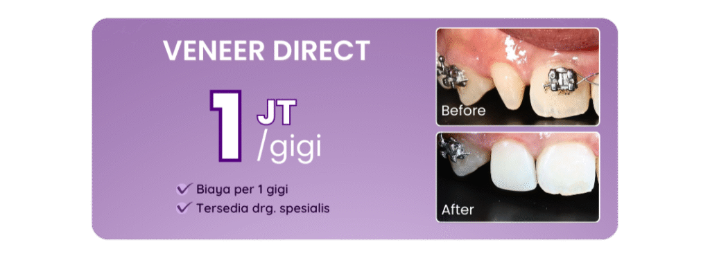 promo-veneer-direct-hai-gigi-premier