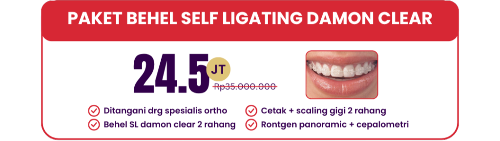self-ligating-damon-clear