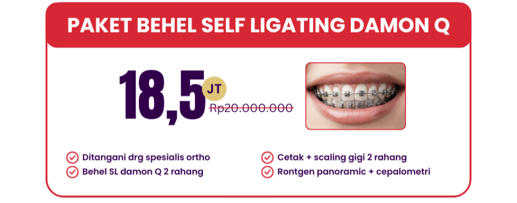 self-ligating-damon-q-hai-gigi-premier