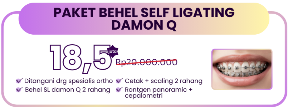 self-ligating-damon-q