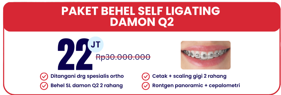 self-ligating-damon-q2-hai-gigi-banyumanik