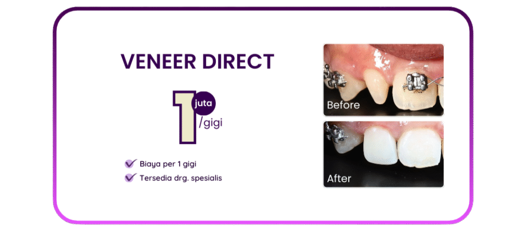 veneer-direct-hai-gigi-premier