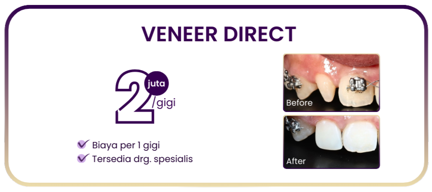 veneer-direct-hai-gigi-premier