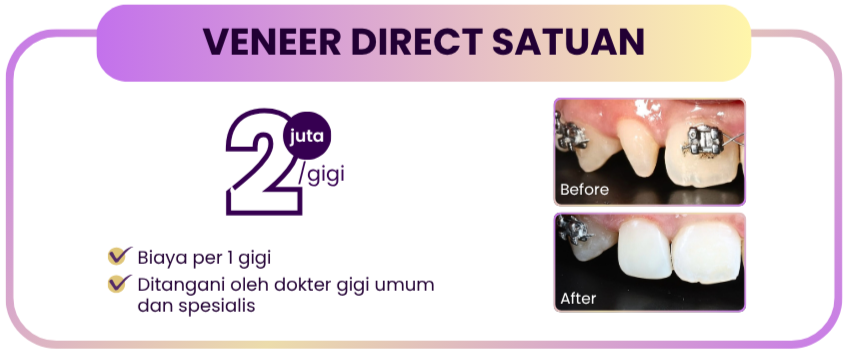 veneer-direct-hai-gigi-premier
