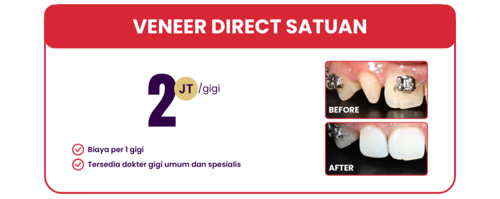 veneer-direct-hai-gigi-premier