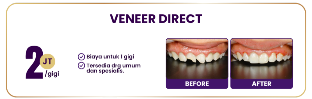 veneer-direct-hai-gigi-premier