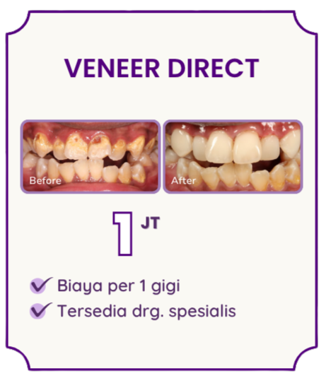 veneer-direct-hai-gigi-premier
