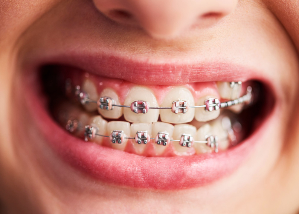 behel-metal