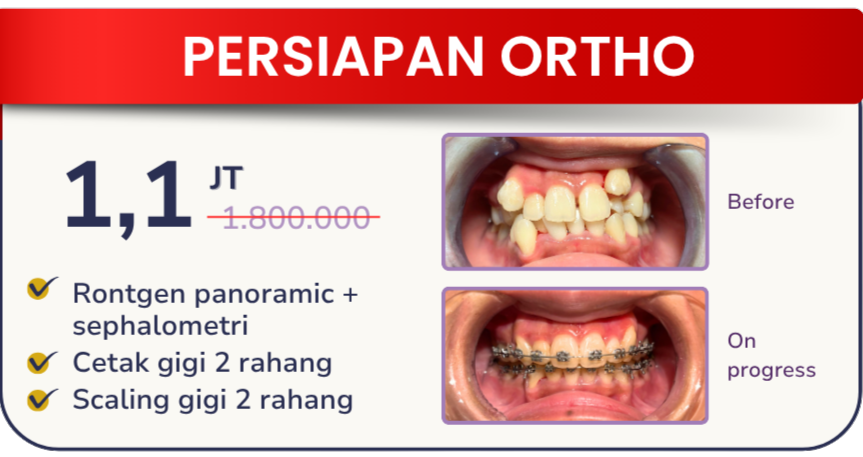 persiapan-orto-hai-gigi-banyumanik