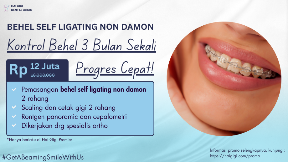 5 Jenis Behel Gigi dan Harganya 5 Jenis Behel Gigi dan Harganya