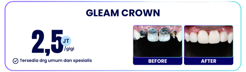 gleam-crown-hai-gigi-banyumanik