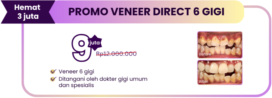 paket-veneer-direct-hai-gigi-premier