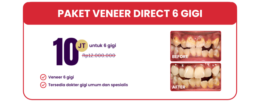 paket-veneer-direct-hai-gigi-premier