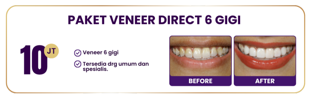 paket-veneer-direct-hai-gigi-premier