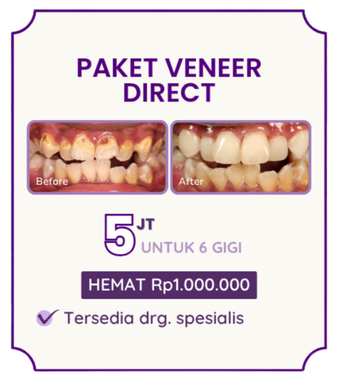 paket-veneer-direct-hai-gigi-premier