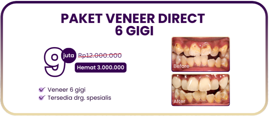 paket-veneer-hai-gigi-premier