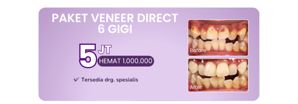 promo-paket-veneer-direct-hai-gigi-premier