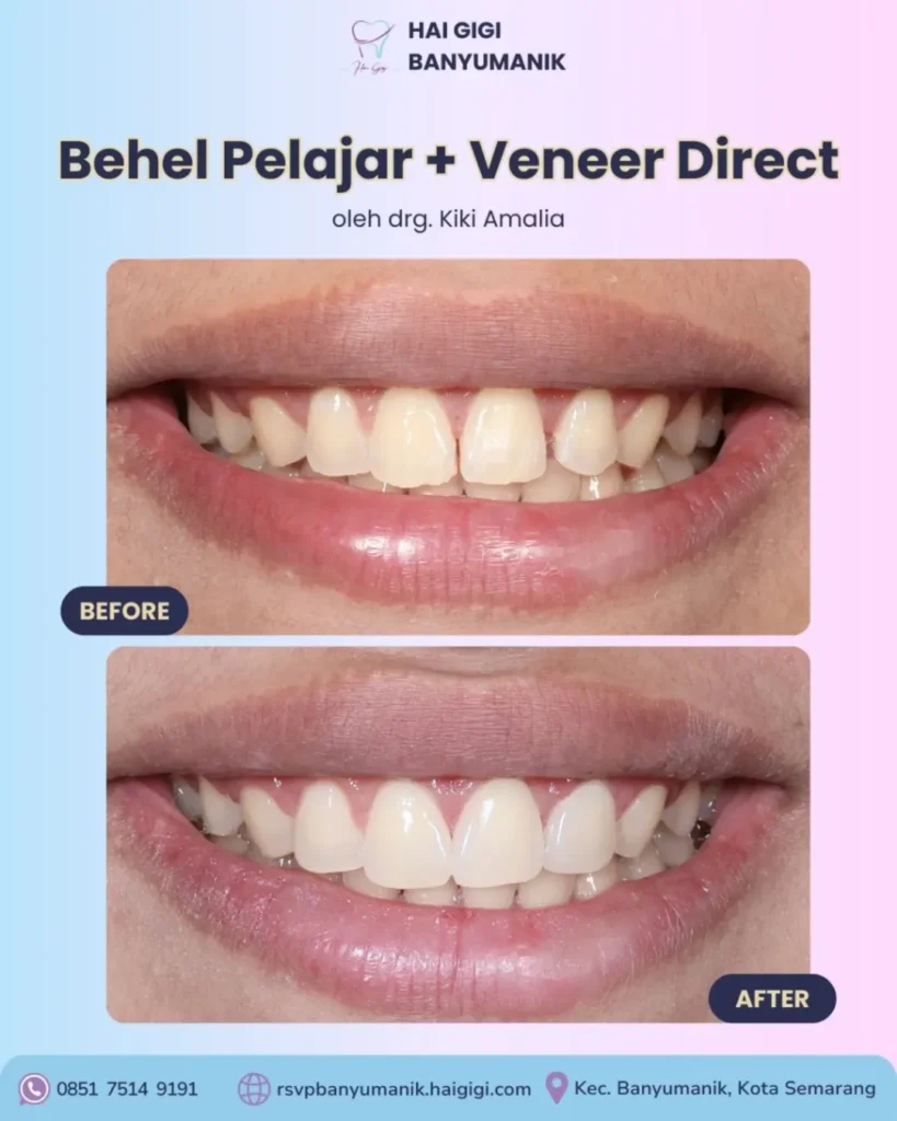 Veneer Gigi behel-pelajar-dan-veneer-direct-2-hai-gigi-banyumanik