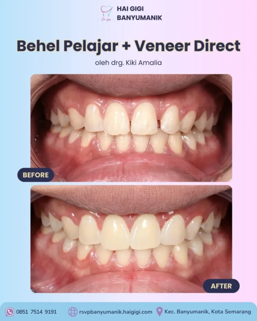 Veneer Gigi behel-pelajar-dan-veneer-direct-3-hai-gigi-banyumanik