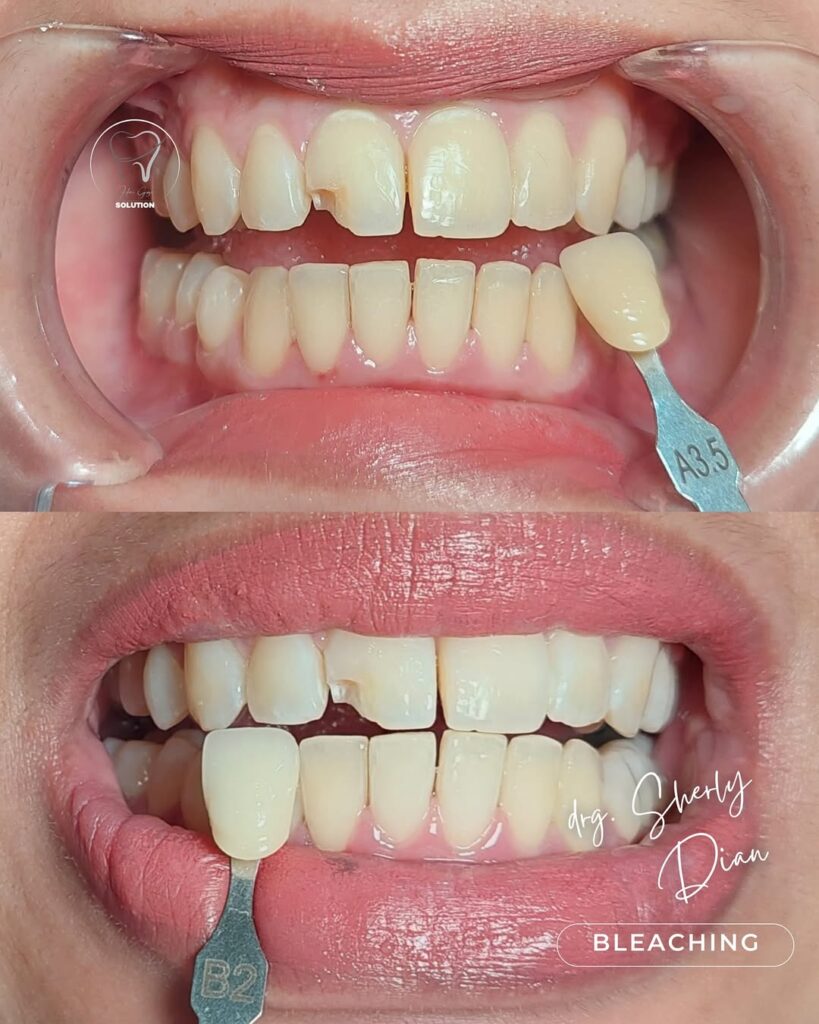 Bleaching Gigi bleaching 3