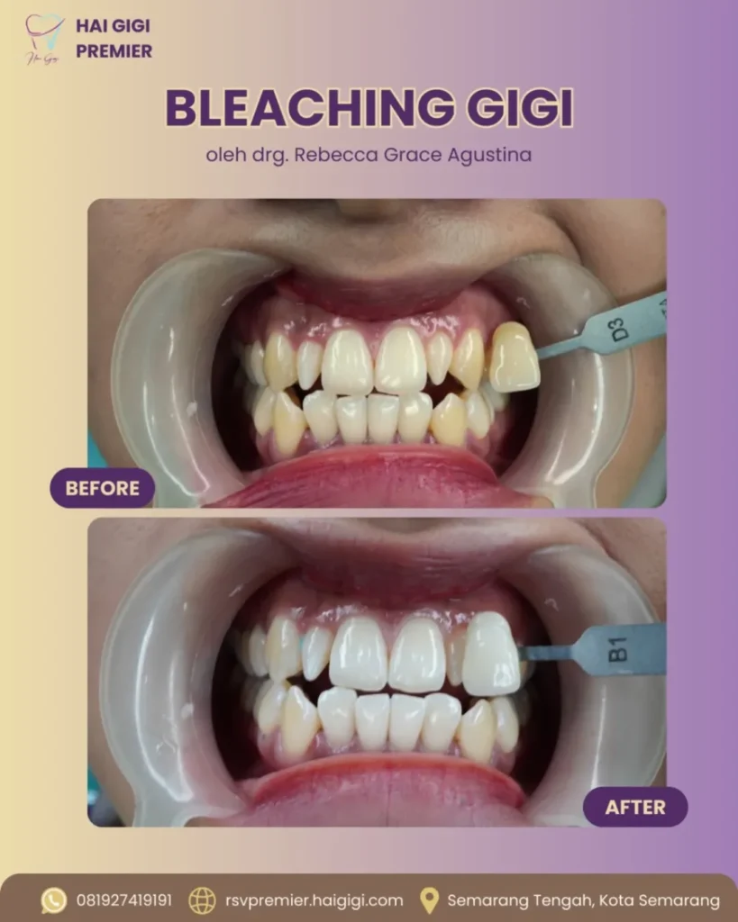 Bleaching Gigi bleaching-gigi-2-hai-gigi-premier (2)