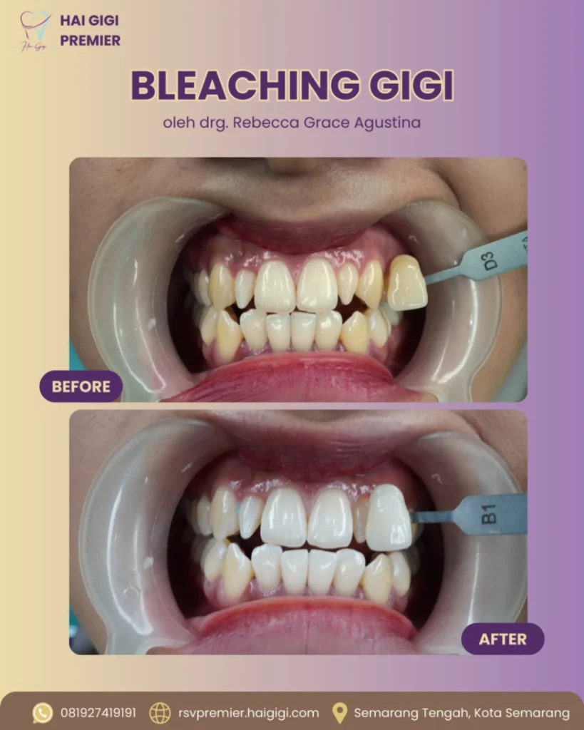 Bleaching Gigi bleaching-gigi-2-hai-gigi-premier