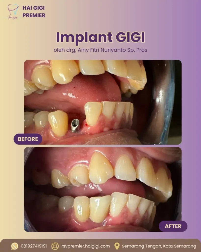 Bleaching Gigi bleaching-gigi-3-hai-gigi-premier