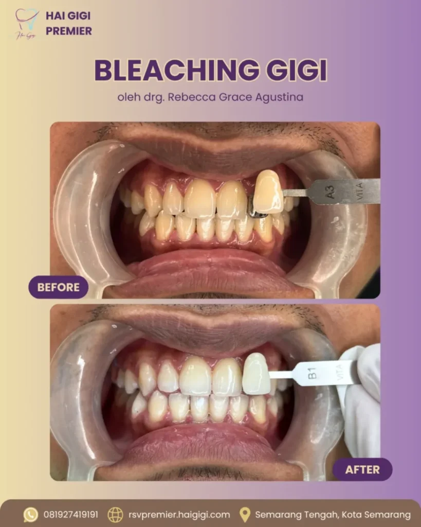 Bleaching Gigi bleaching-gigi-4-hai-gigi-premier