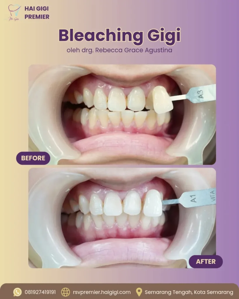 Bleaching Gigi bleaching-gigi-5-hai-gigi-premier