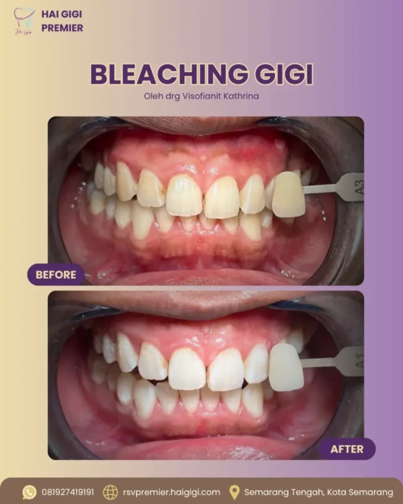 Bleaching Gigi bleaching-gigi-6-hai-gigi-premier