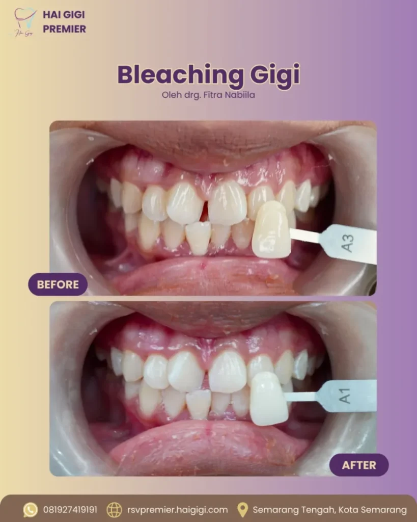 Bleaching Gigi bleaching-gigi-7-hai-gigi-premier