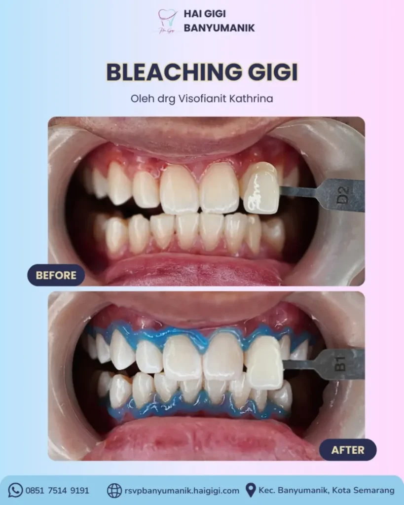 Bleaching Gigi bleaching-gigi-hai-gigi-banyumanik (2)