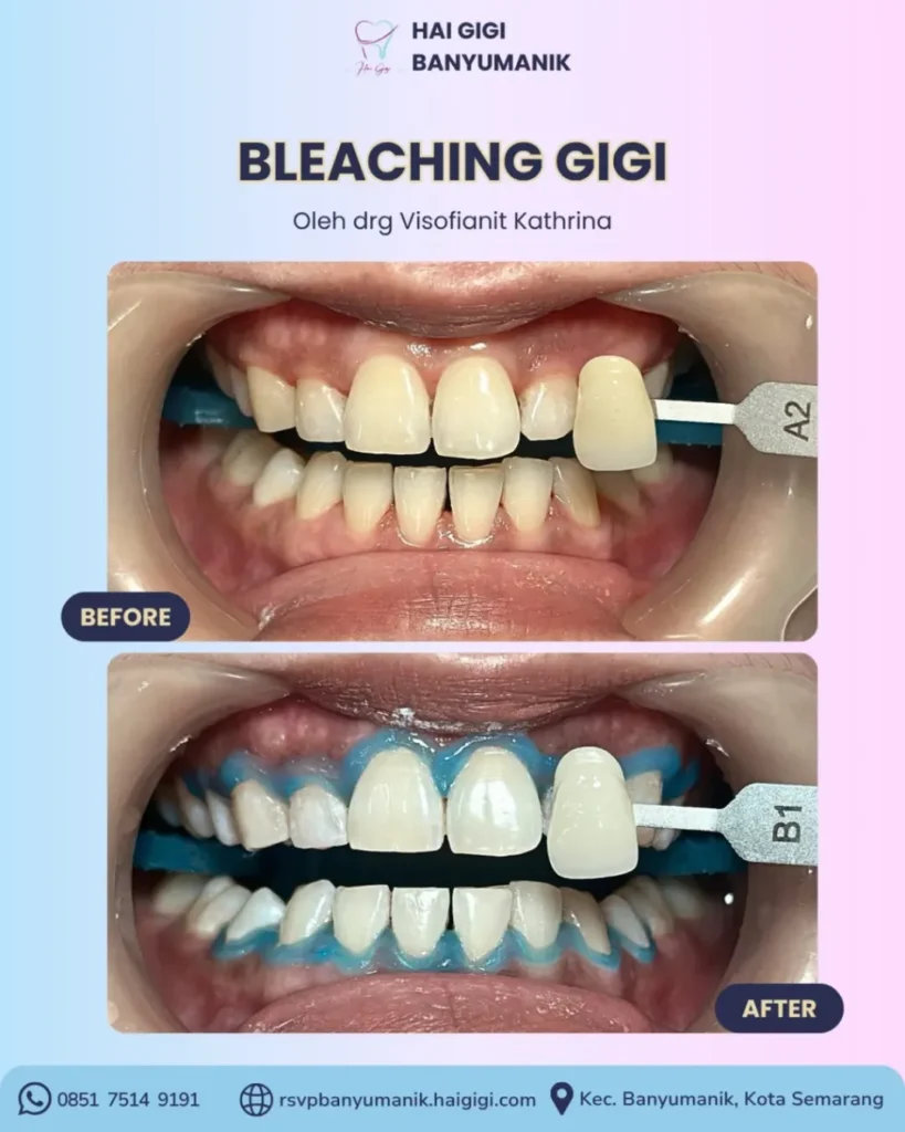 Bleaching Gigi bleaching-gigi-hai-gigi-banyumanik (3)