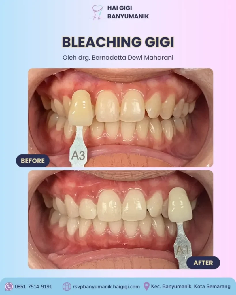 Bleaching Gigi bleaching-gigi-hai-gigi-banyumanik