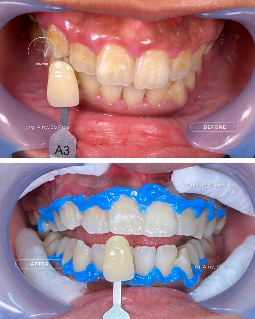 Bleaching Gigi bleaching-gigi-hai-gigi-premier