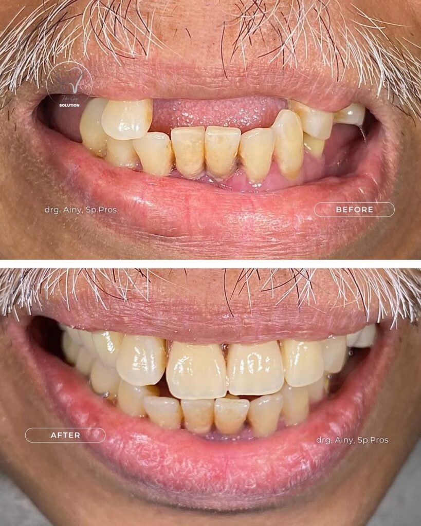 Implan Gigi (done) implan 3