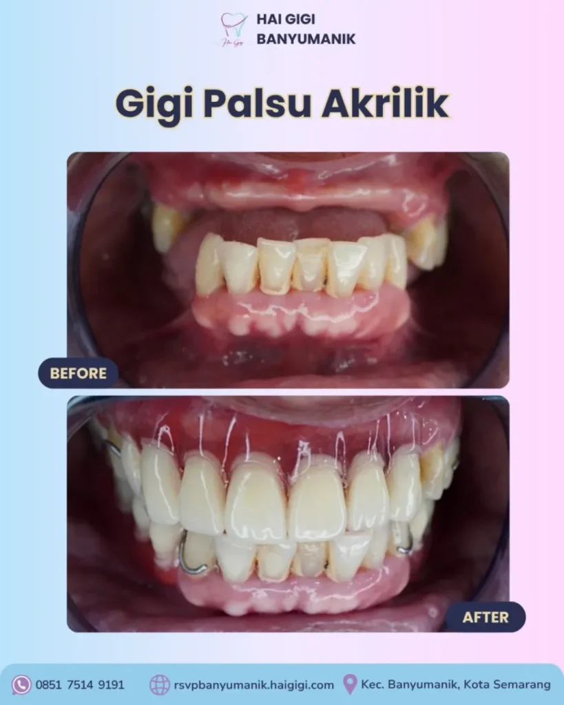 Gigi Palsu gigi-palsu-akrilik-2-hai-gigi-banyumanik