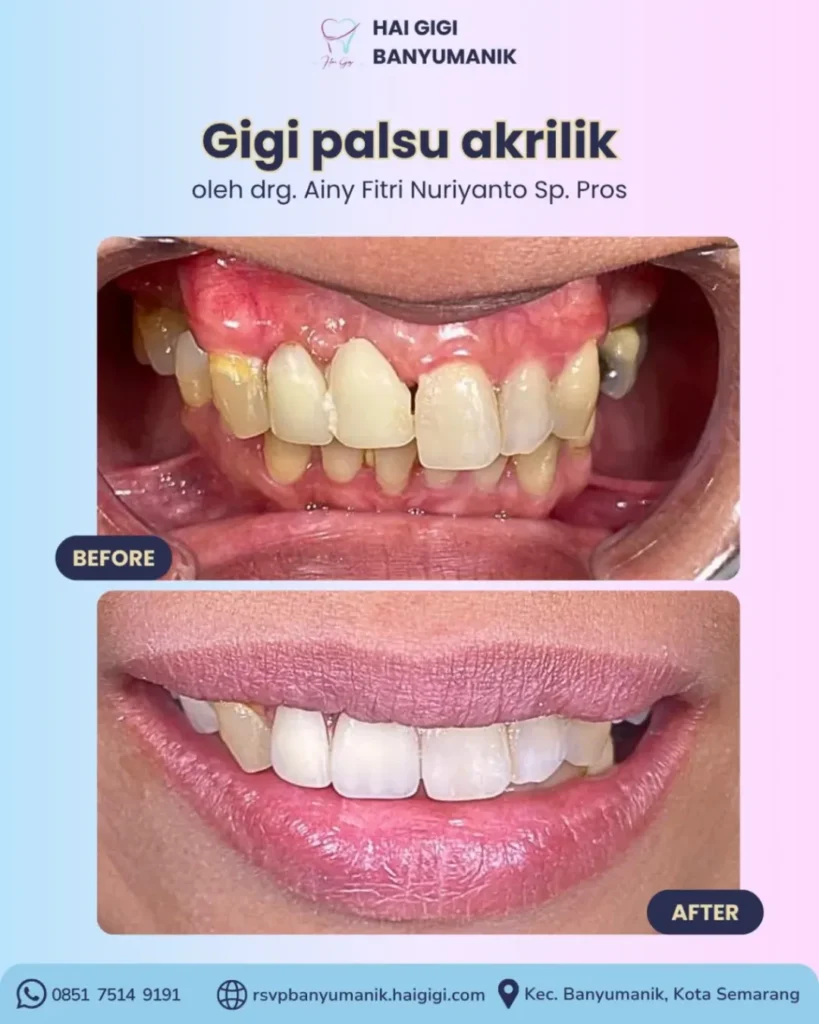 Gigi Palsu gigi-palsu-akrilik-hai-gigi-banyumanik
