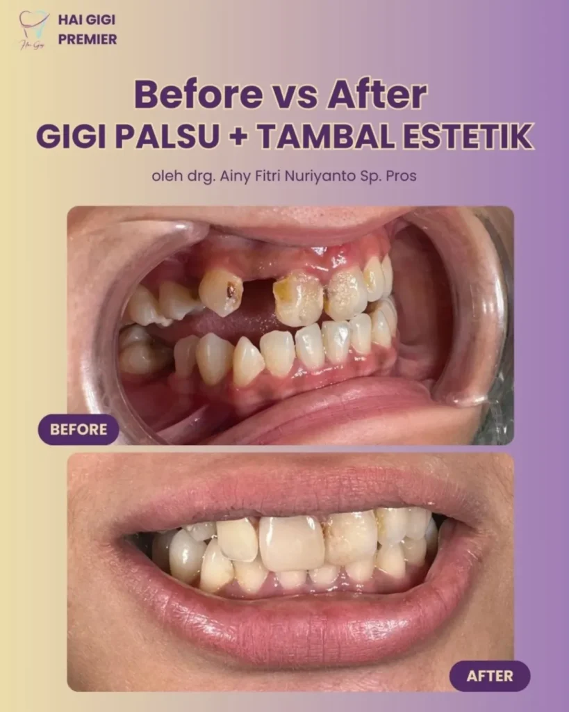 Gigi Palsu gigi-palsu-dan-tambal-gigi-estetik-hai-gigi-premier