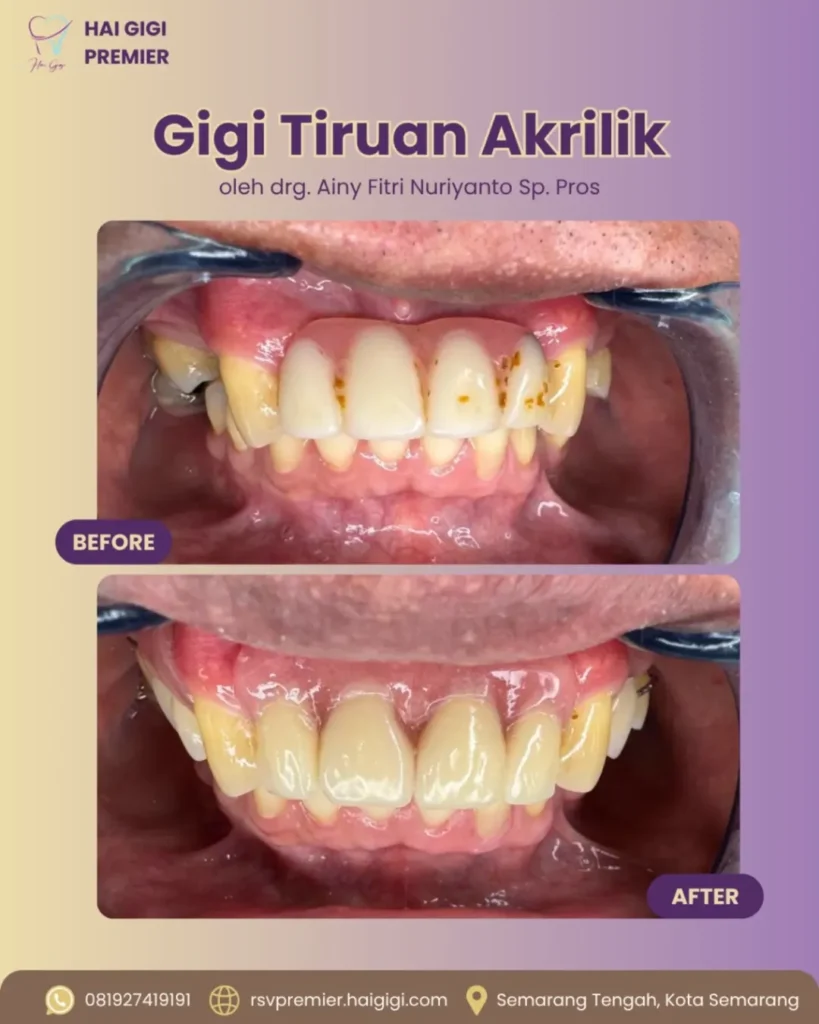 Gigi Palsu gigi-tiruan-akrilik-hai-gigi-premier