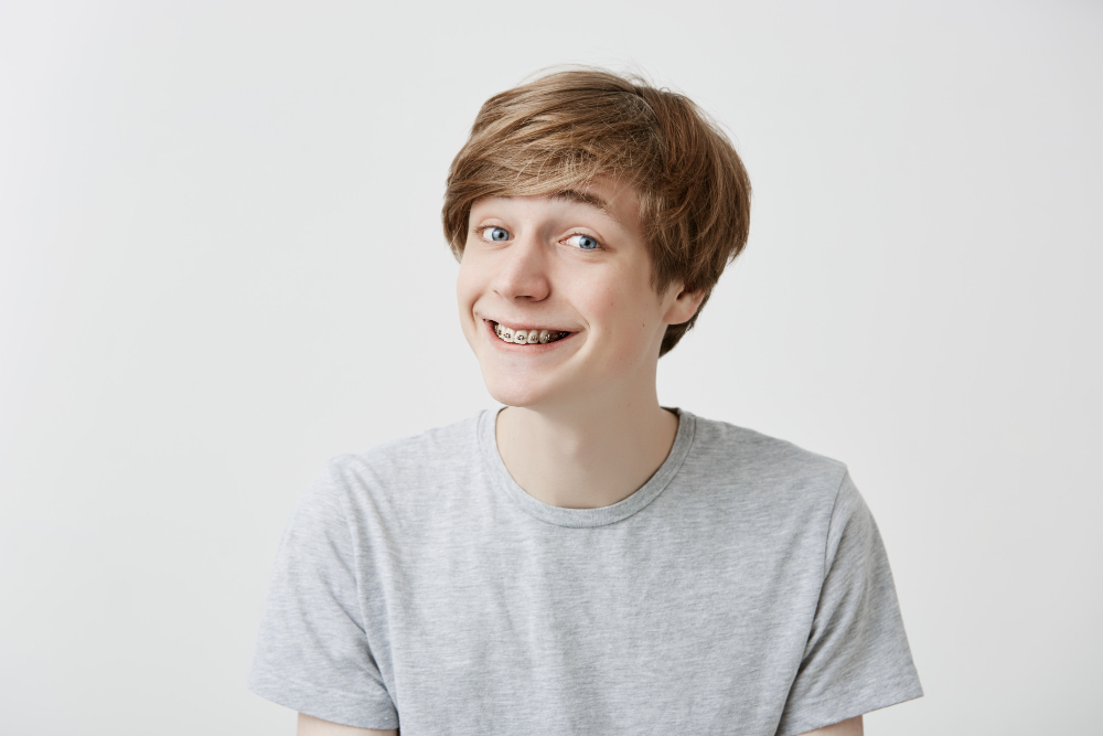 ilustrasi-behel-self-ligating (3)