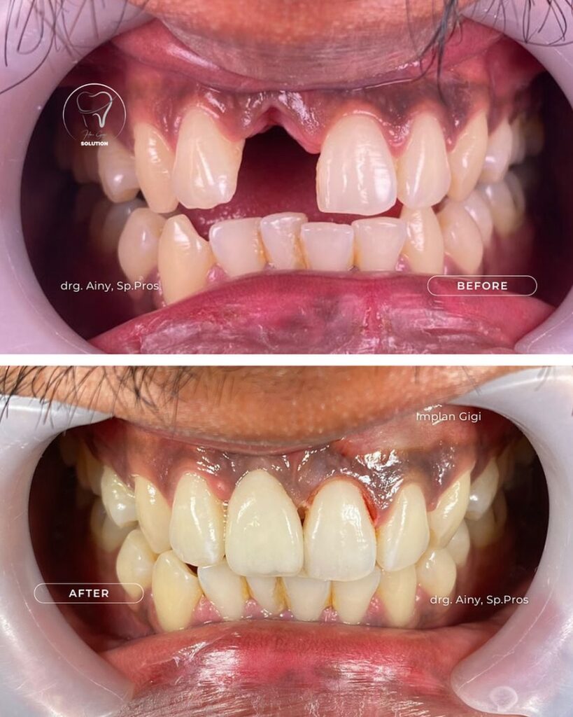 Implan Gigi implan-gigi-2-hai-gigi-premier
