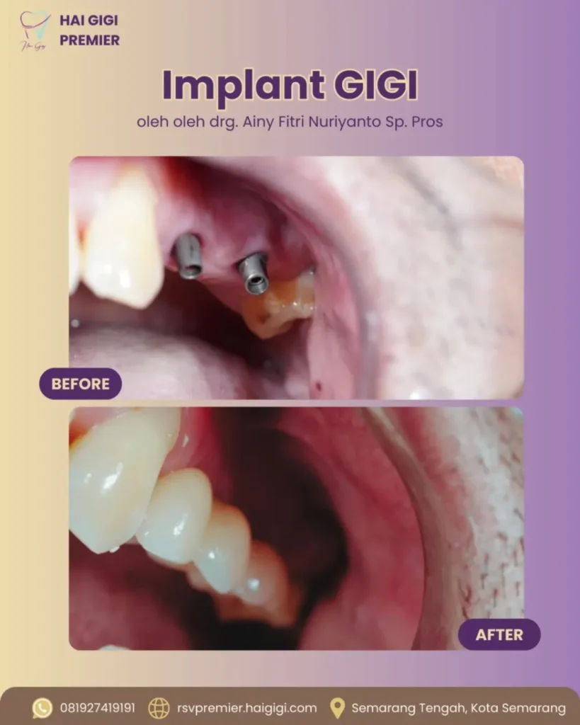 Implan Gigi implan-gigi-2-hai-gigi-premier