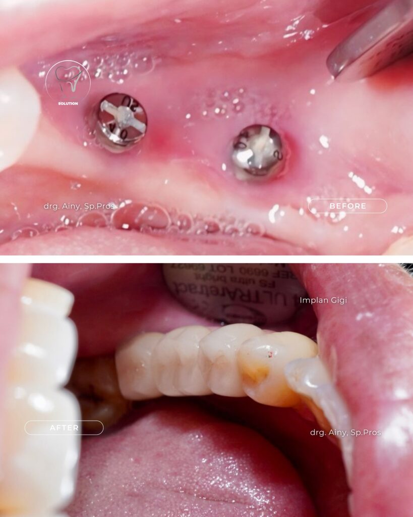 Implan Gigi implan-gigi-hai-gigi-premier