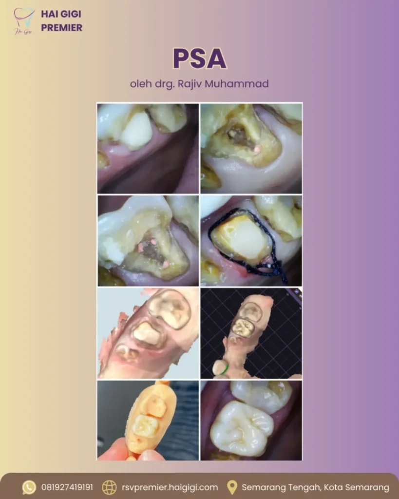 Perawatan Saluran Akar perawatan-saluran-akar-2-hai-gigi-premier