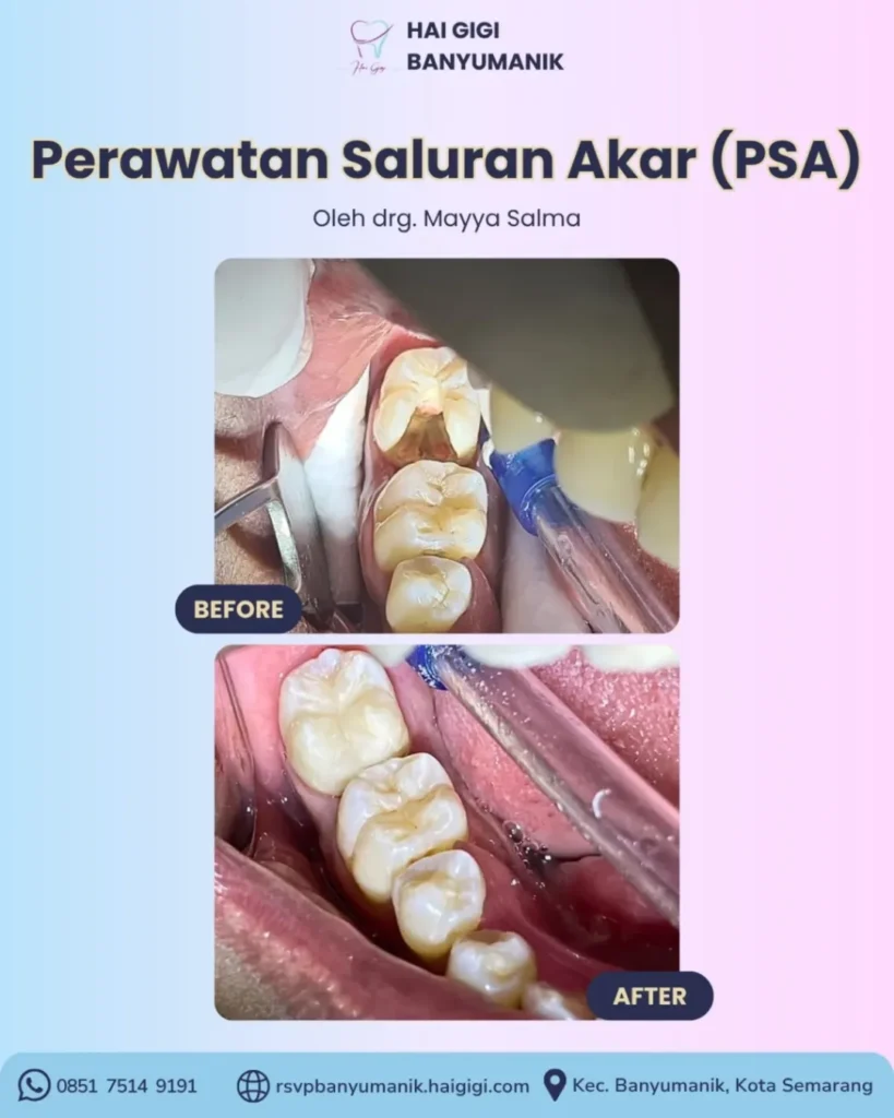 Perawatan Saluran Akar perawatan-saluran-akar-hai-gigi-banyumanik