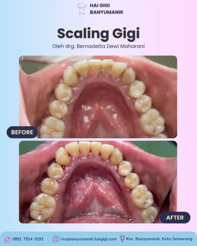 Scaling Gigi scaling-gigi-3-hai-gigi-banyumanik