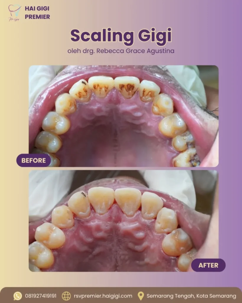 Scaling Gigi scaling-gigi-4-hai-gigi-premier