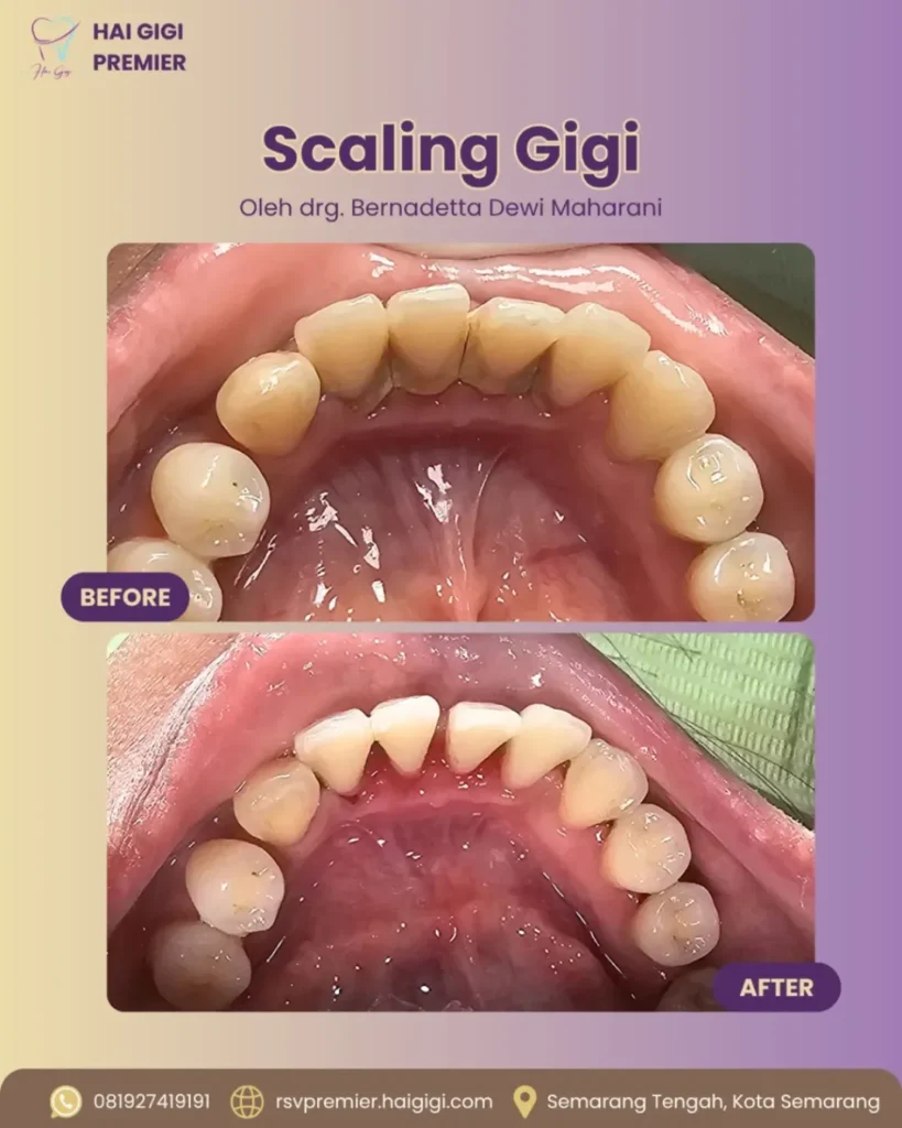 Scaling Gigi scaling-gigi-5-hai-gigi-premier