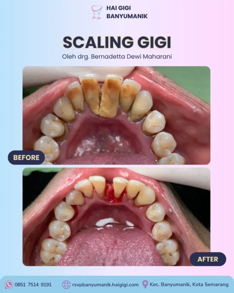 Scaling Gigi scaling-gigi-6-hai-gigi-banyumanik